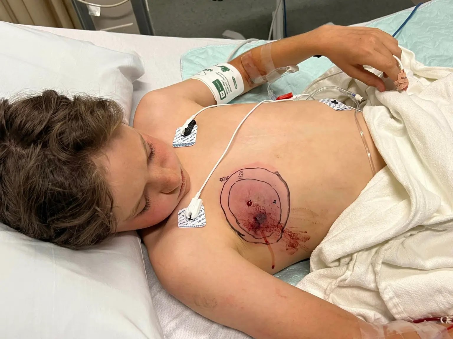 Ethan Vogel bitten by a snake